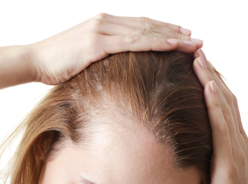 Alopesi areata (Saç Kıran) nedir?